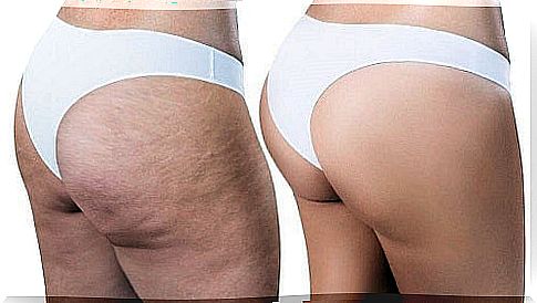 2 natural remedies to reduce cellulite