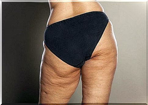 Woman who needs natural remedies to reduce cellulite