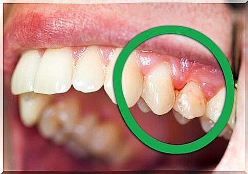 20 natural remedies for gingivitis