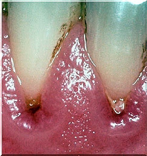 Form of severe gingivitis