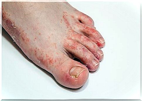 3 remedies for foot fungus