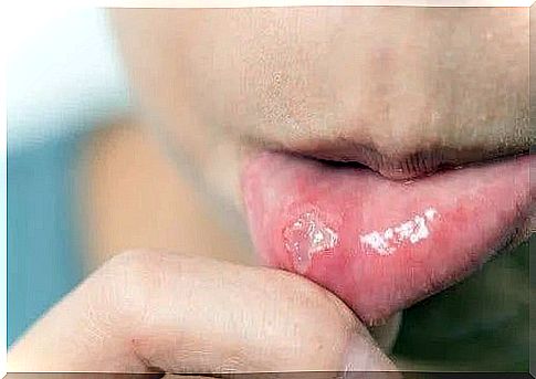 5 treatments for canker sores