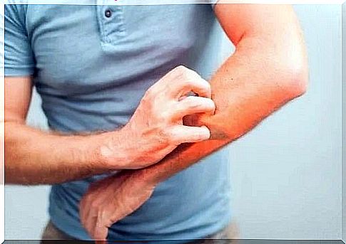 5 natural remedies for itching