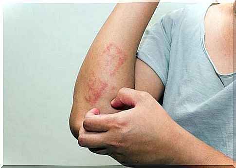 Natural creams to relieve itchy psoriasis