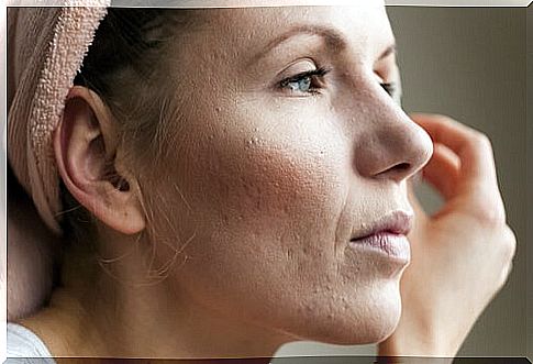 Symptoms of high levels of cortisol on a woman's skin