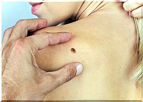 6 symptoms of skin cancer