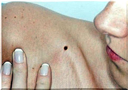 Symptoms of skin cancer like irregular moles