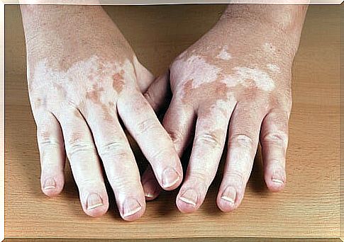 Vitiligo affects people of all ages