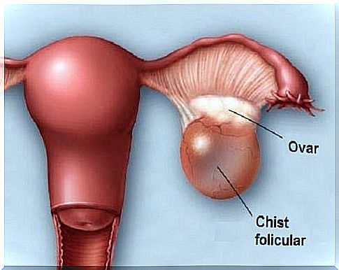 Abdominal pain in the left side caused by the ovary