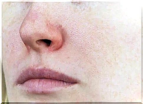 Characteristics and treatments for rosacea