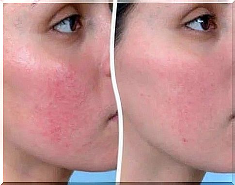 Skin before and after applying treatments for rosacea