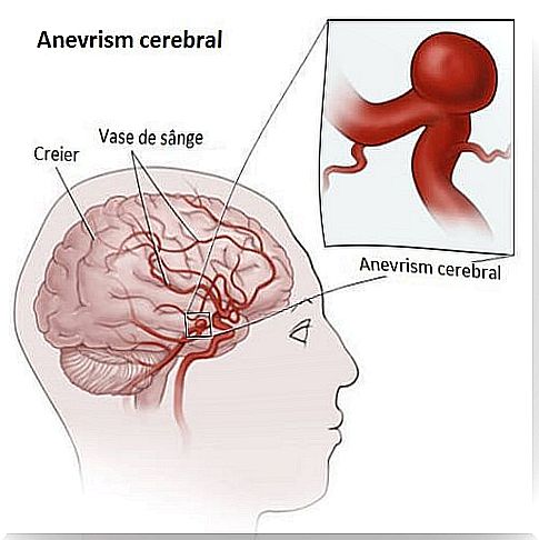 Detection of cerebral aneurysms