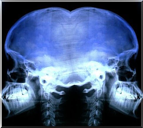 Radiography for the prevention and treatment of osteoporosis