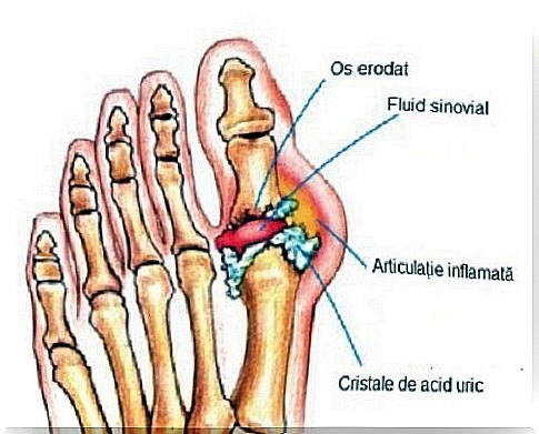 Get rid of uric acid crystals in the joints