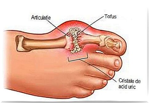 Get rid of uric acid crystals from the toes