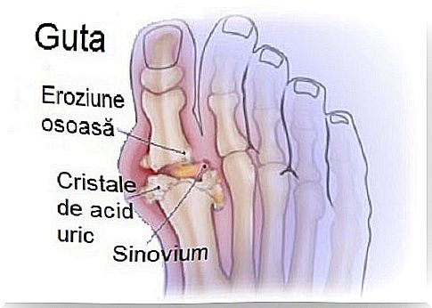 How to get rid of uric acid crystals that cause gout