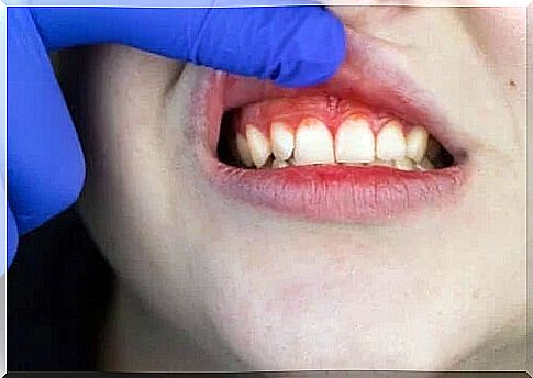 The origin, symptoms and treatment of the trench mouth