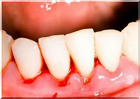 Teeth affected by trench mouth