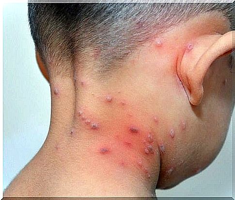 Scalded skin syndrome in children