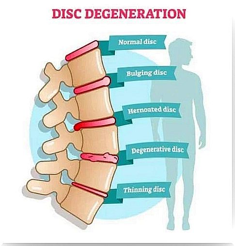 Symptoms of disc degenerative disease