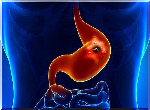 Burning on the list of symptoms of gastroduodenal ulcer