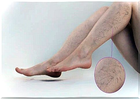 The best exercises for varicose veins