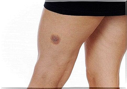 The best quick remedies for bruising