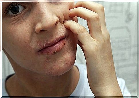 Perioral dermatitis