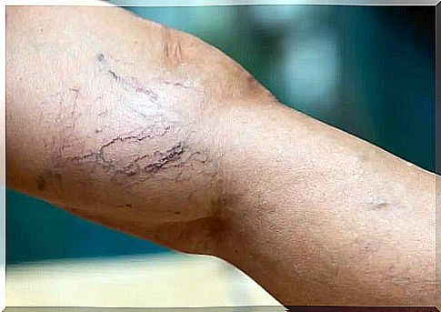 Person in need of treatment for varicose veins with micros foam