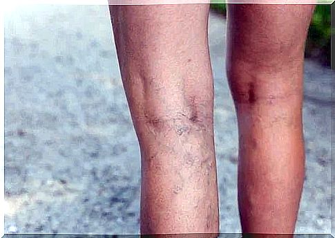 The need to apply a treatment for varicose veins with garlic