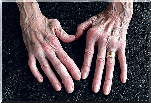 Hands affected by rheumatoid arthritis