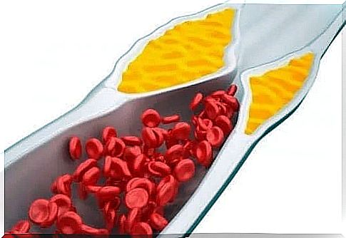 Cholesterol deposited on the arteries