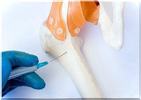 Extraction of the bone marrow with a syringe