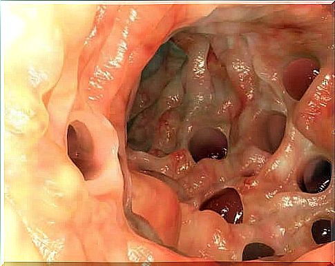 What is the Meckel diverticulum?